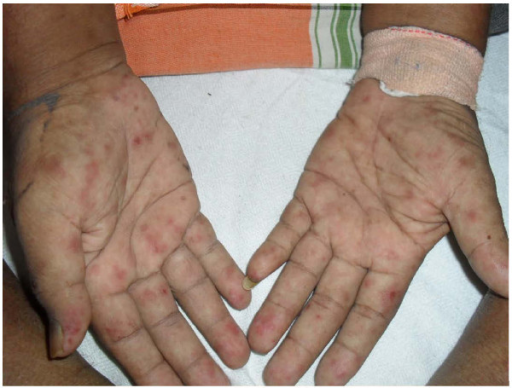 Generalized Erythematous Rash Extending To Palms And So Open I