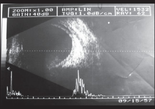 Left Eye USG B Scan Choroidal Detachment Left Eye USG B Scan Choroidal Detachment
