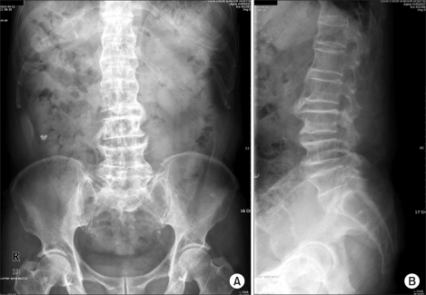 Plain radiographs showing hyperostosis with marked bone | Open-i