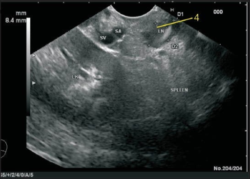 The lienorenal ligament is seen as a structure between | Open-i