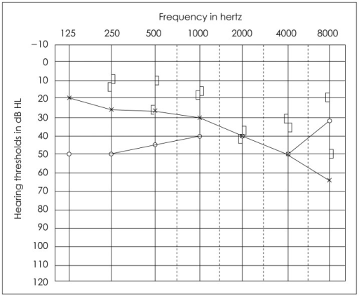 An example of audiogram in a patient with otosclerosis | Open-i