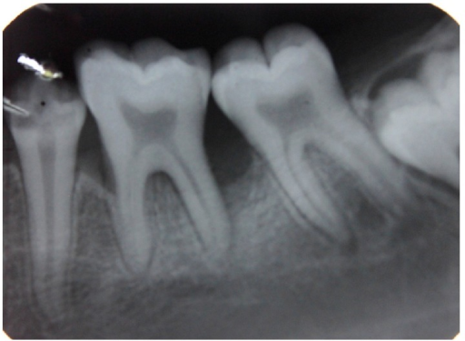 Intraoral Periapical Radiograph Showing Vertical Bone L | Open-i