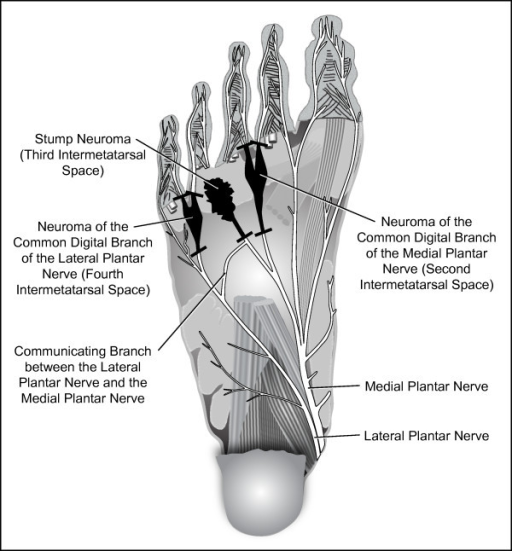 Illustrative plantar view of the second, third, and fou | Open-i