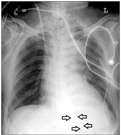 Portable Chest Radiograph Shows The Tip Of The Swan Ganz Catheter Sgc ...