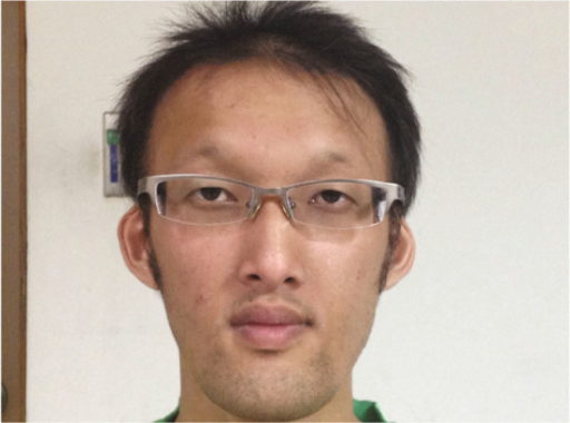 Frontal Bossing Prominent Supraorbital Ridge Sunken C Open I The study of frontal bossing has been mentioned in research. frontal bossing prominent supraorbital
