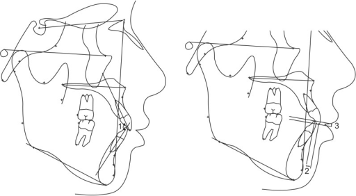 Cephalometric measurements of interdental relationship. | Open-i