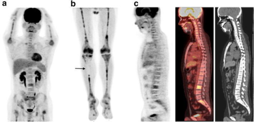 18F-FDG PET/CT Images Of A 24-year-old Man With B-cell | Open-i