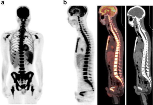 18F-FDG PET/CT Images Of A 24-year-old Man With B-cell | Open-i