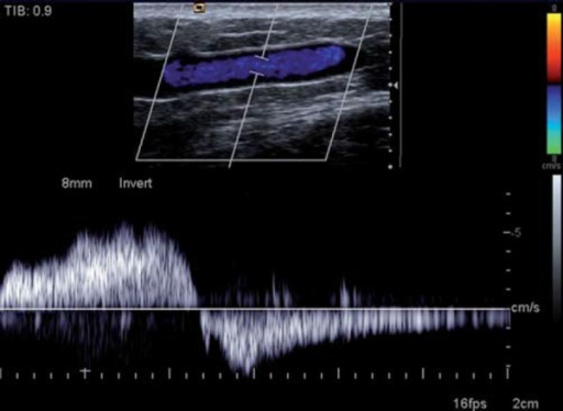 Refluxing superficial vein. Reflux in the GSV is seen f | Open-i