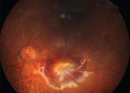 Central Fibrosis And Subretinal Hemorrhage In The Area Consistent With Penetration Site Which Was Central Fibrosis And Subretinal Hemorrhage In The Area Consistent With Penetration Site Which Was