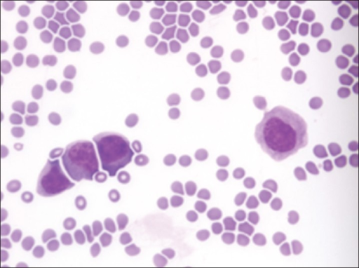 Abnormal blasts in Bcell nonHodgkin's lymphoma Openi