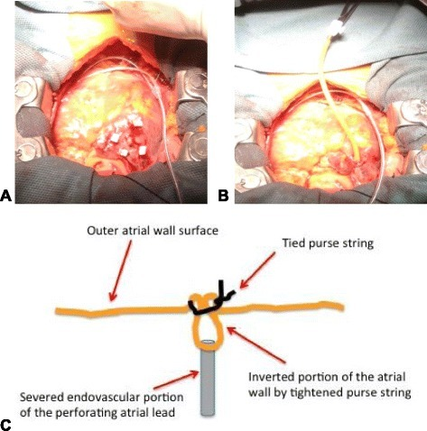JCM | Free Full-Text | The “Woggle” Technique for Venous Access  Site Management: An Old Technique for a New Need