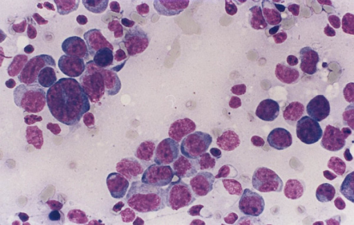 A case of diffuse large B cell lymphoma with limited am Openi