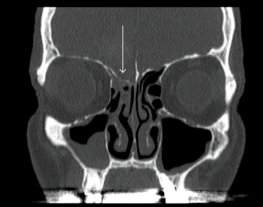 Ethmoid roof is lower on the right side (arrow). Corona | Open-i