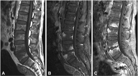 Lumbar spine MRI of the patient. Sagittal T1-weighted ( | Open-i