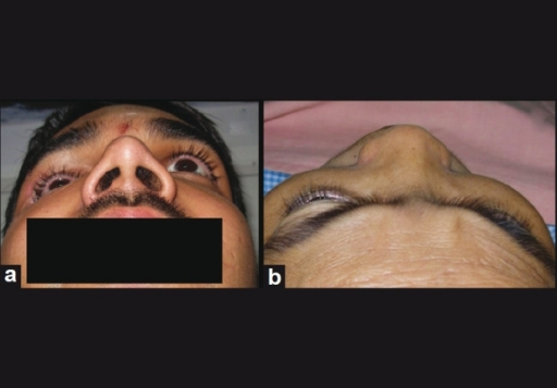 Enophthalmos and proptosis: Worm's eye view (a) and Bir | Open-i