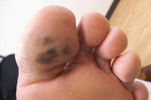 black bottom foot spot Thanatos eros freud