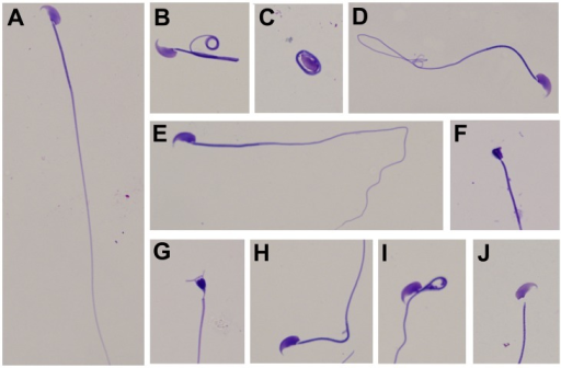 and birth defects Misshapen sperm