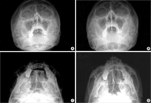 (A) Preoperative skull Waters view, (B) Postoperative s | Open-i