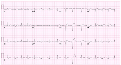 Sinus arrhythmia, with PVC. Anteroseptal infarct. | Open-i