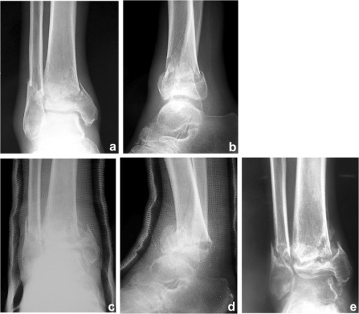 Pre-operative plain radiograph of Dorso-lumbar spine in (1A