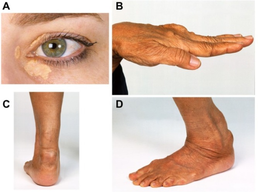 Discrete Clinical Manifestations Of Familial Hypercholesterolemia A Corneal Arcus And 5882