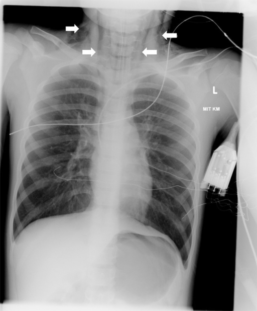 chest-x-ray-showing-hyperinflated-lungs-and-a-discrete-open-i