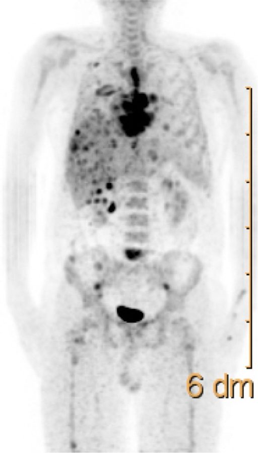 Maximum intensity projection image 18F-FDG PET-CT shows | Open-i