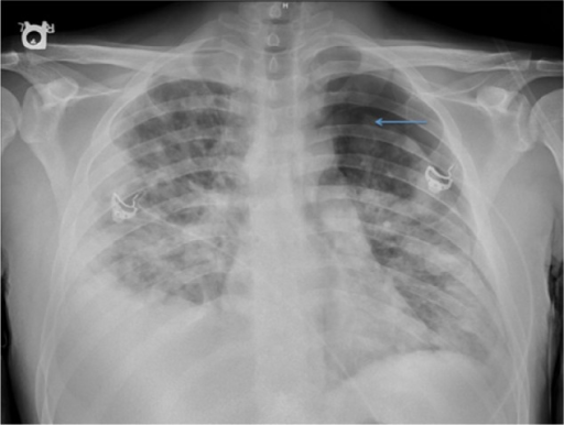 Chest x-ray showing bilateral infiltrates, left pneumot | Open-i