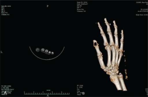 These images show enchondroma in the distal phalanx of | Open-i