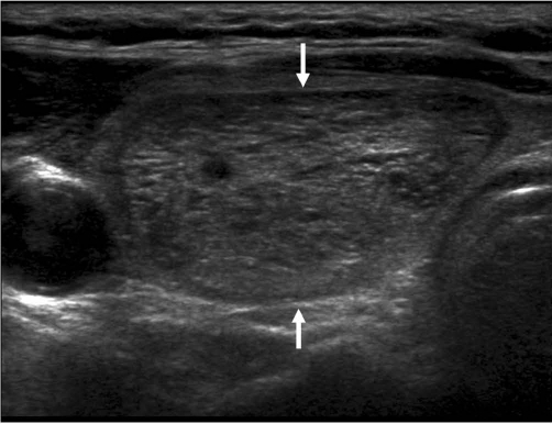 Spongiform Nodule Ultrasound