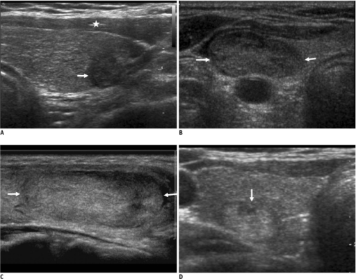 Echogenicity Of Thyroid Nodulesa Marked Hypoechogenic Open I