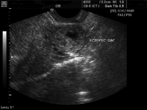 Transvaginal sonography showing ectopic gestational sac | Open-i