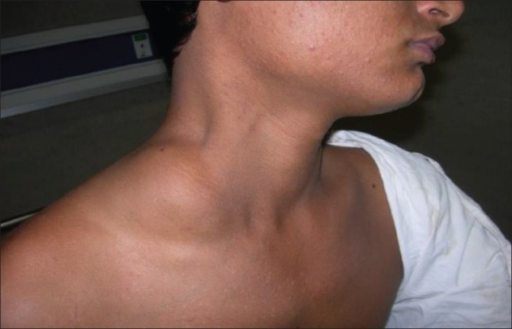 Pictures Of Patients With Clavicular Swelling 63