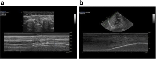 Ultrasound and non-ultrasound imaging techniques in the assessment of  diaphragmatic dysfunction, BMC Pulmonary Medicine
