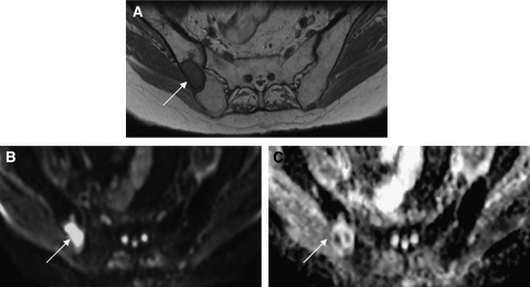 A male patient with prostate cancer metastases to bone. | Open-i