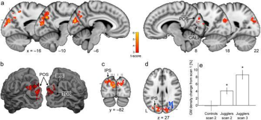 Gray Matter Density Increases During >> Gray Matter Density Increases After Juggling Training Open I Gray Matter Density Increases During >> Gray Matter Density Increases After Juggling Training Open I