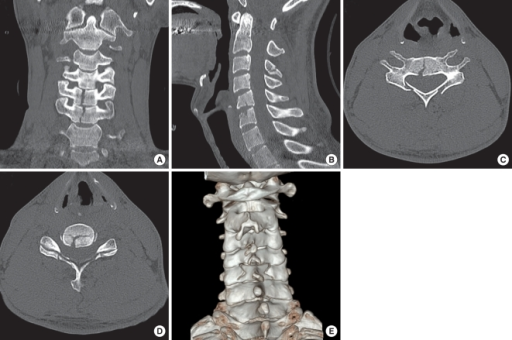 c7 transverse process fracture