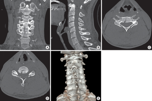 Cervical spine computed tomographic (CT) scans with 3-d ...