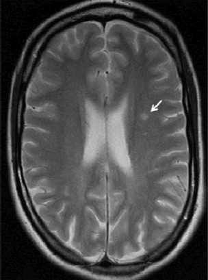 White Spots On Brain MRI