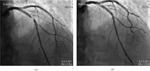 (a) Baseline Coronary Angiogram (LAO 40°, CRA 38°) An | Open-i