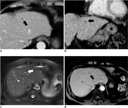 50 Year Old Man With Group I E2 89 A4 5 Mm Hepatic Cyst 50 Year Old Man With Group I E2 89 A4 5 Mm Hepatic Cyst