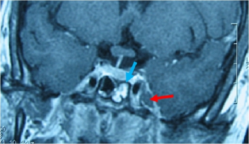 Thrombose Du Sinus Caverneux Gauche Associé à Une Sph | Open-i