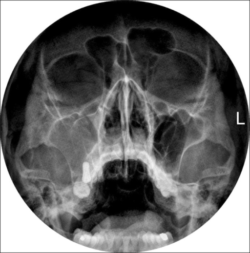 Sinusitis Waters View