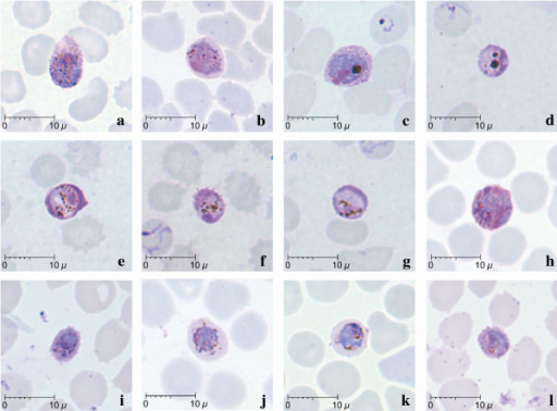 Gametocytes Of P. Knowlesi Parasites In Human Infection | Open-i