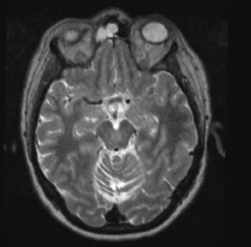 Magnetic resonance imaging T2 Axial view. Bilateral com | Open-i