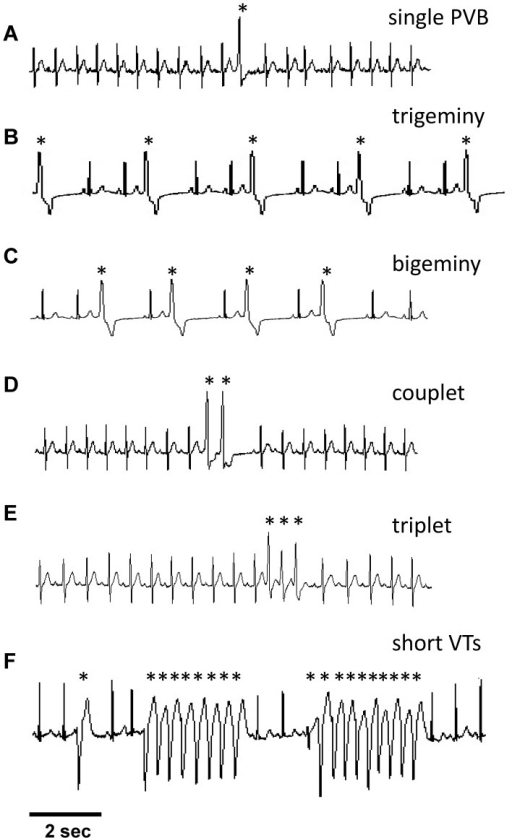 Typical experimental ECG recordings showing the differe | Open-i