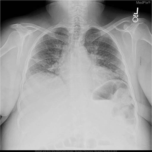 PA view shows hypoinflated lungs with increased pulmonary markings ...