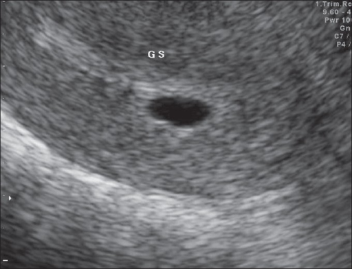 on-3-12-07-showing-a-single-intrauterine-gestational-s-open-i