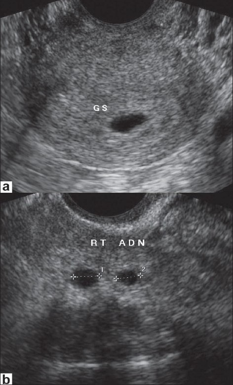 (a) On 8-12-07, showing an intrauterine gestational sac | Open-i